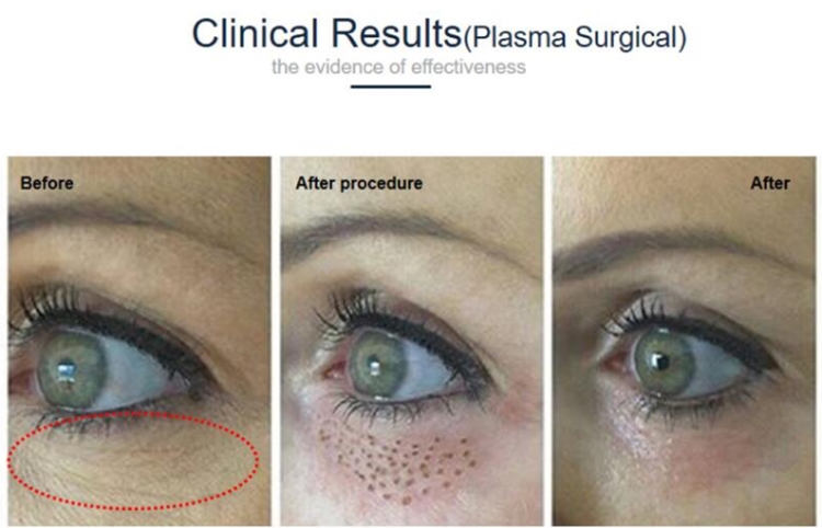2 in 1 machine plasma needle surgical plasma shower acne removal