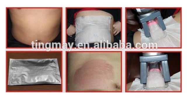 Professional laser cryolipolysis mini massage device/cryolaser TM-908